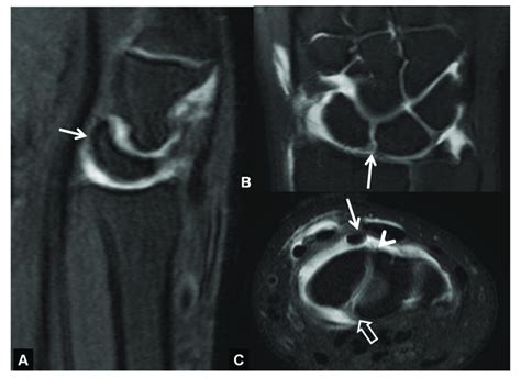 DISI in a 66-year-old-male patient with SLAC wrist. (A) Sagittal MR ...