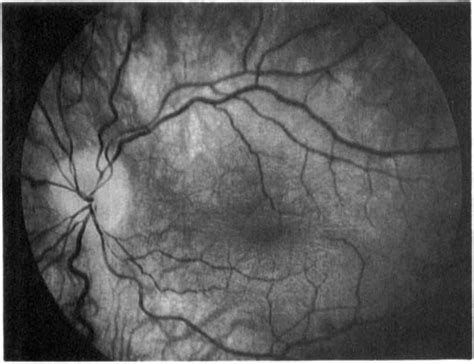 The optic disc is now pale. | Download Scientific Diagram