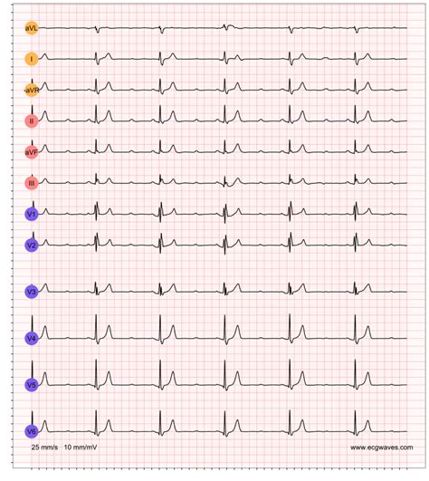 Second-degree AV block: Mobitz type 1 (Wenckebach) & Mobitz type 2 block – Cardiovascular Education