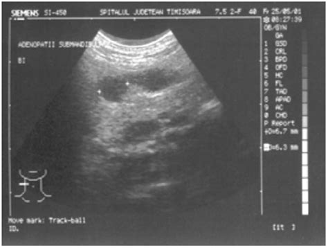 -Ultrasound of the neck: reactive lymph nodes. | Download Scientific Diagram