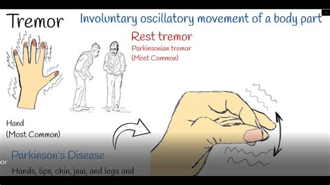 Tremor - Shaking hands (hand tremors) Causes and treatment. Parkinson ...