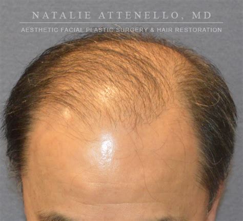 Beverly Hills Hair Restoration Before and After Photos - Los Angeles Plastic Surgery Photo ...