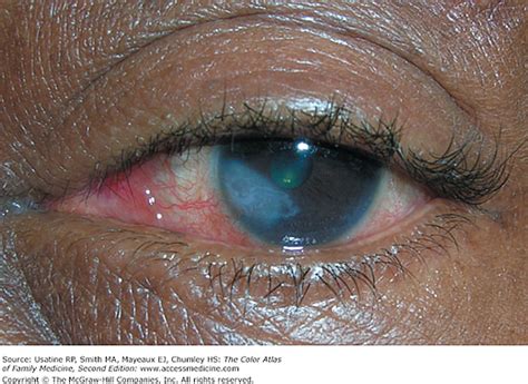 Herpetic keratitis | AccessMedicine Network