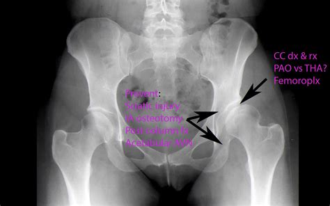 Endoscopy-Assisted Periacetabular Osteotomy - Arthroscopy Techniques