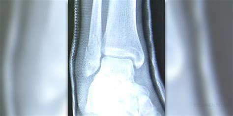 Fibula fracture healing time | General center | SteadyHealth.com