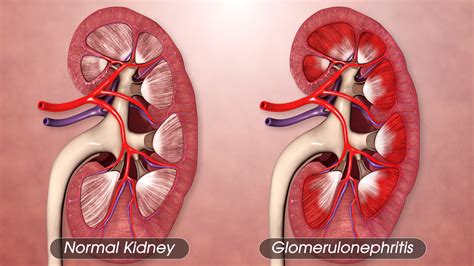 Glomerulonephritis Causes Symptoms Treatment | Urology Omaha