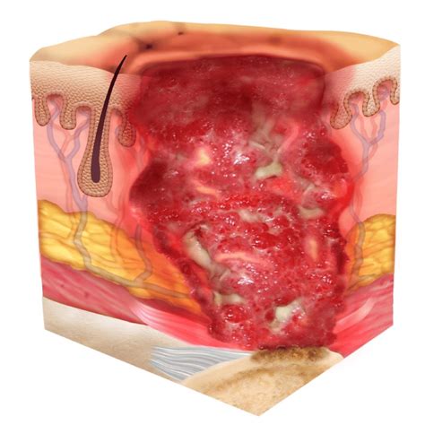 Pressure Injury 101: Stage 4 Pressure Ulcers