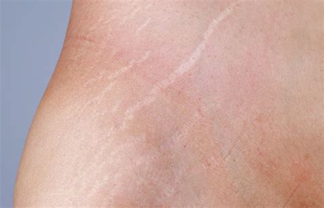 How To Get Rid Of White Stretch Marks?