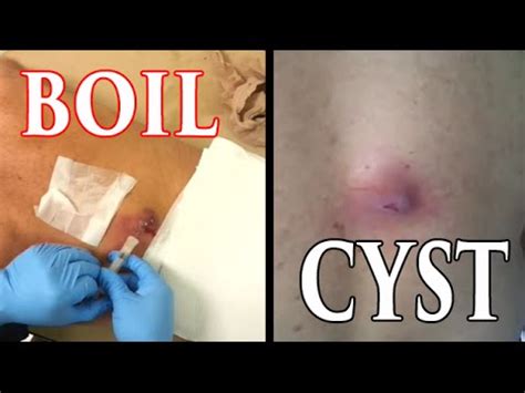 boil infection Vs huge cyst on back ! How to popping - YouTube