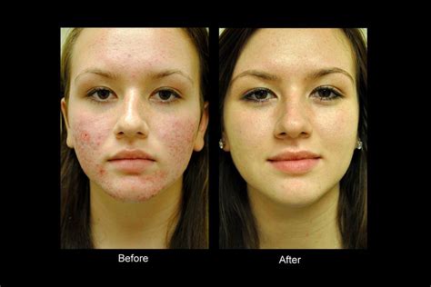 Best Acne Scars Treatment Products: Acne Treatments - Is Dermabrasion For Acne Scars the Best ...