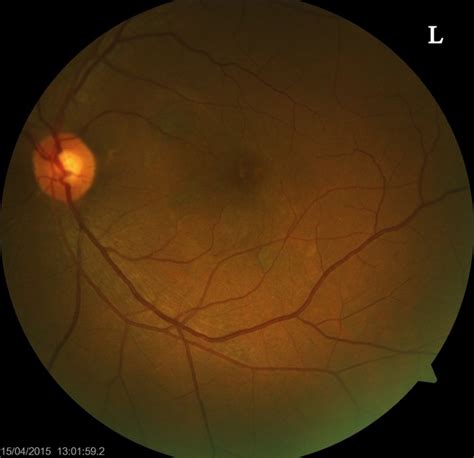 Eye examination for eye diseases - Evershine Optical