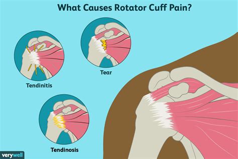 Rotator Cuff Pain: Treatment, Symptoms, Causes, and More