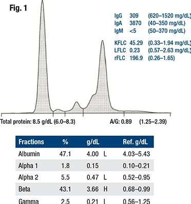 Immunofixation Shows Igm Monoclonal Protein With Kappa Light Chain ...