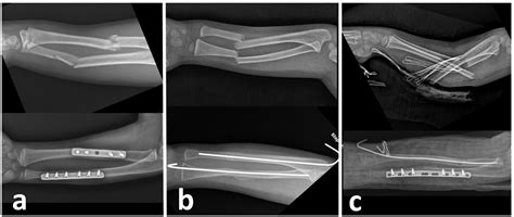 Cureus | Comparison of Three Different Surgical Fixation Techniques in Pediatric Forearm Double ...