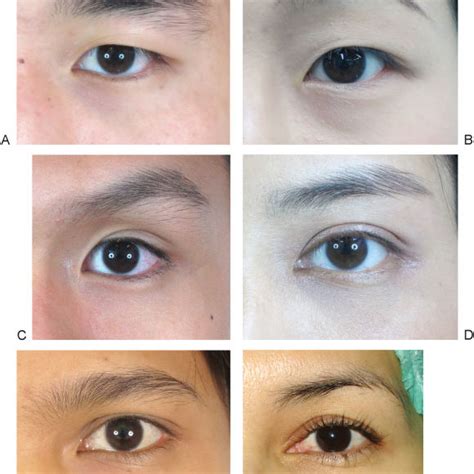 (PDF) The Asian Eyelid: Relevant Anatomy