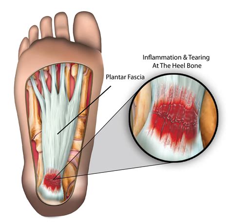 Plantar Fasciitis - Symptoms and Management | SportNova UK