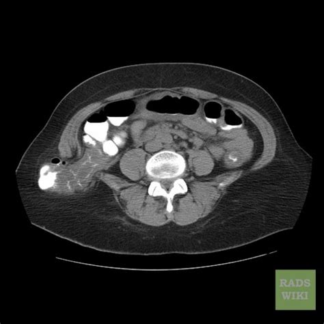 Lumbar hernia - wikidoc