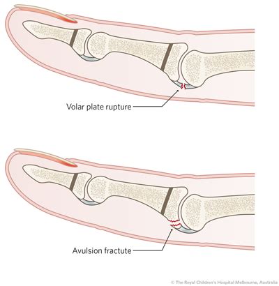 Clinical Practice Guidelines : Phalangeal Finger Fractures