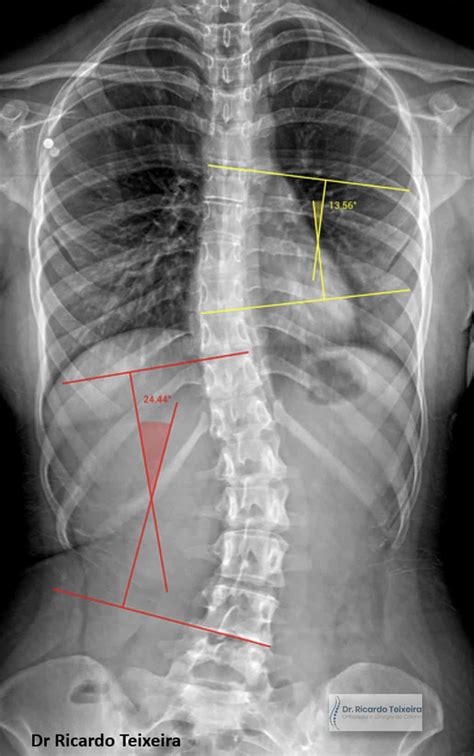 Ângulo de Cobb: Diagnóstico para os casos de Escoliose