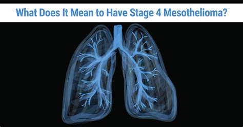 Stage 4 Mesothelioma: How to Treat It & Improve Prognosis