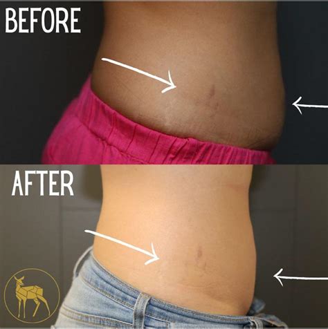 stretchmarks- solutions - Lexington, KY: Jazzi Cosmetic Surgery ...