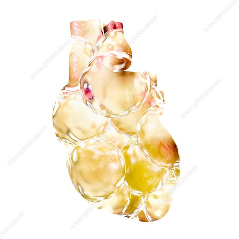 Fatty heart, conceptual illustration - Stock Image - F020/9511 - Science Photo Library