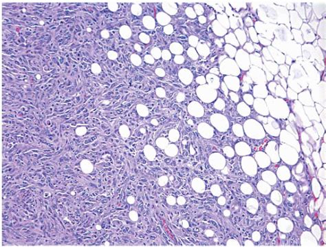 Spindle Cell Lesions | Oncohema Key