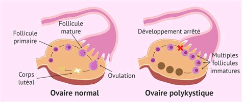 Ovaire normal VS Ovaire polykystique