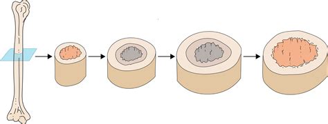 Interstitial Bone Growth