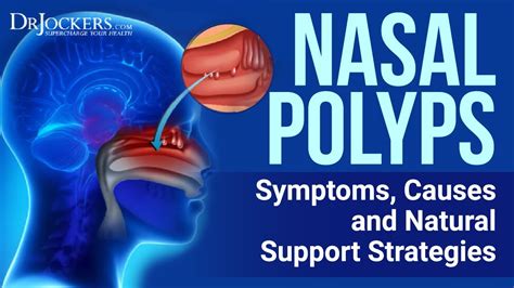 Top 12 Natural Remedies for Nasal Polyps - YouTube