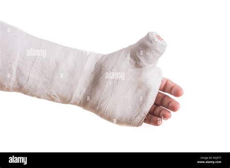 Thumb spica cast hi-res stock photography and images - Alamy