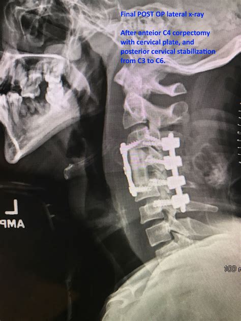 cervical corpectomy – Matthew Lawson, M.D.