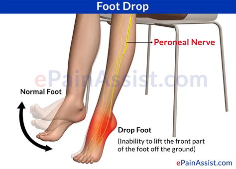 Foot Drop|Symptoms|Treatment|Exercises|Recovery