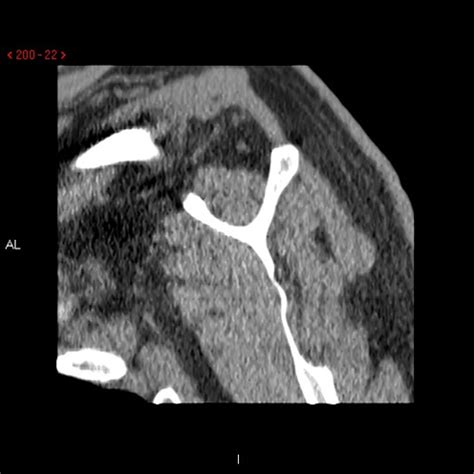 CT Arthrogram Shoulder: R/O Rotator Cuff or Labral Tear | Cedars-Sinai