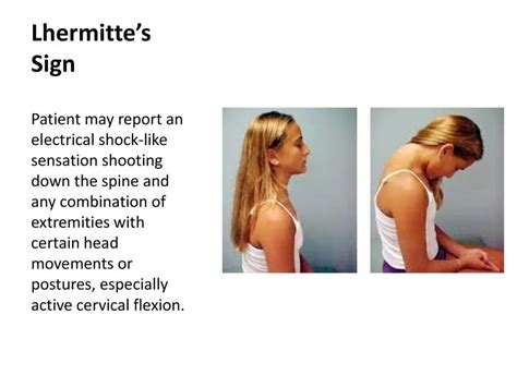 Lhermitte's sign - Cause, Treatment - Mobile Physio