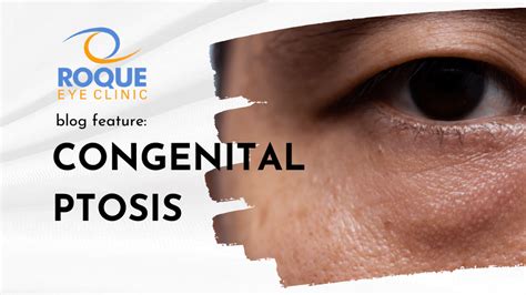 Congenital Ptosis - ROQUE Eye Clinic | Eye.com.ph