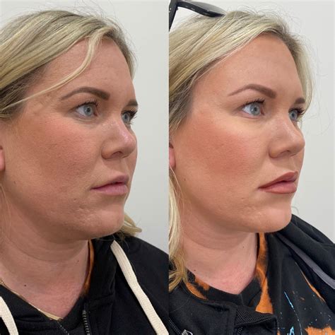 Kybella Before & After Images | Medspa in Newport Beach, CA