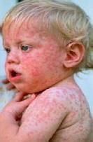 » German Measles Symptoms and Treatment