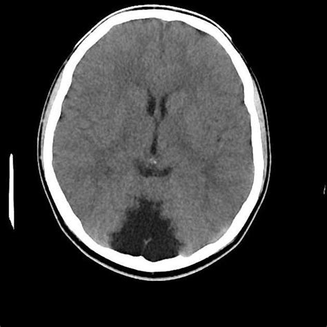 Mega Cisterna Magna - Prominent cisterna magna appearing as a wedge shaped area of CSF density ...