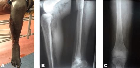 Gas gangrene: (A) Necrotic patch on the right leg, (B) Gas in the soft... | Download Scientific ...