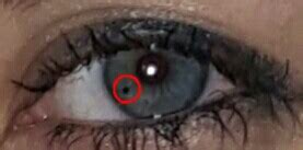 optometry - What is this dot on the iris? - Medical Sciences Stack Exchange