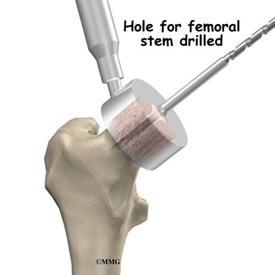 Hip Resurfacing Arthroplasty | eOrthopod.com