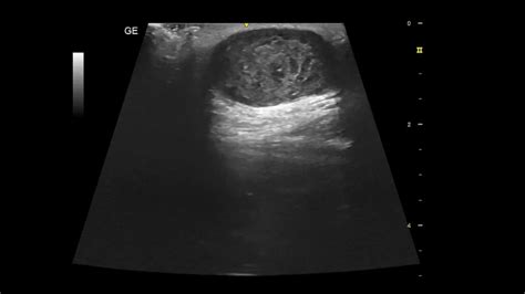 Subcutaneous Dermoid Cyst Ultrasound