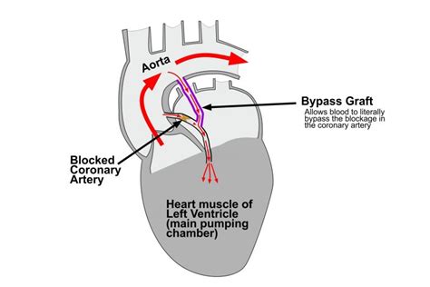 Coronary Artery Bypass Grafting