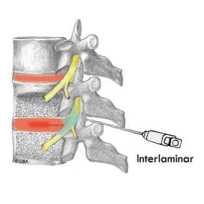 Thoracic Interlaminar Epidural Steroid Injection - Sarasota, FL & Oviedo, FL: Pain Medicine Group