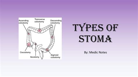 Types of stoma - colostomy/ileostomy/urostomy, end/loop/double-barrel ...