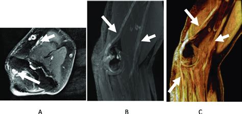 Mononeuritis multiplex. Axial 2D fsT2W image (a) and oblique sagittal... | Download Scientific ...