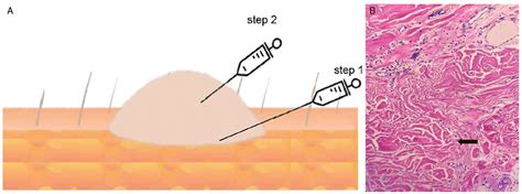 Modified injection technique for improving the treatment of keloids | Chinese Medical Journal