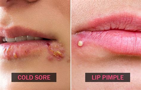 Cold Sores Vs. Pimples: How They Look, Causes, & Treatment