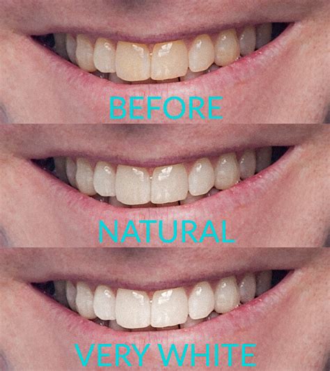 How to Whiten Teeth in Photoshop